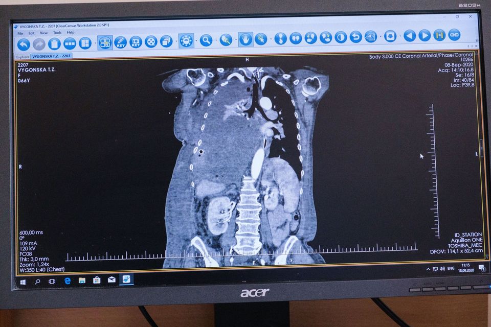В "Феофании" медики провели операцию по удалению 4,5-килограмовой опухоли. Фото: facebook.com/president.gov.ua